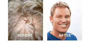 Shane Warne Before and After Hair Loss