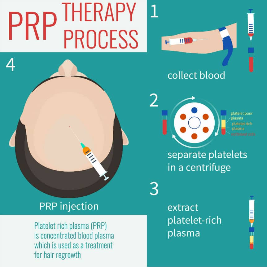 What Is PRP Treatment Therapy Procedure For Hair Loss